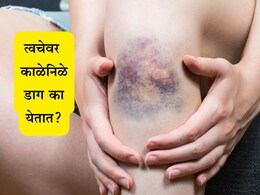 Nutrients Deficiency: दुखापत न होताच शरीर वारंवार काळेनिळे पडतंय? तुमचं आरोग्य देतंय गंभीर संकेत, दुर्लक्ष करू नका