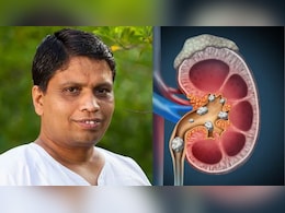 इस एक चीज को खाने से कभी नहीं होगी पथरी, Acharya Balkrishna ने बताया Kidney Stone का असरदार तोड़ इस एक चीज को खाने से कभी नहीं होगी पथरी, Acharya Balkrishna ने बताया Kidney Stone का असरदार तोड़