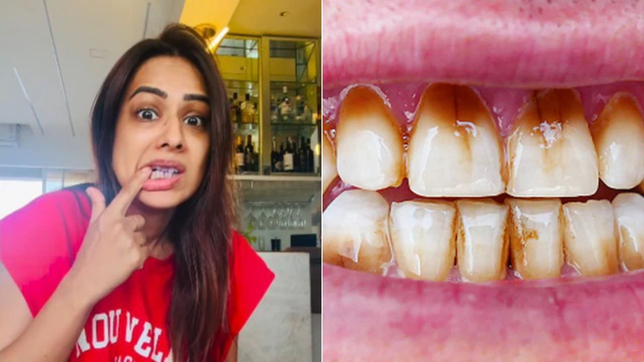 Nia Sharma ने बताया दांतों को सफेद करने का नुस्खा, कहा मोती जैसे दिखेंगे Teeth, डॉक्टर से जानें कितना अच्छा है ये हैक