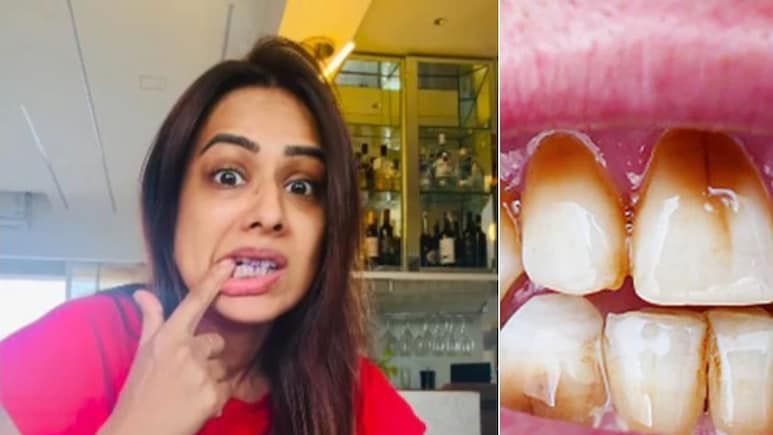 Nia Sharma ने बताया दांतों को सफेद करने का नुस्खा, कहा मोती जैसे दिखेंगे Teeth, डॉक्टर से जानें कितना अच्छा है ये हैक