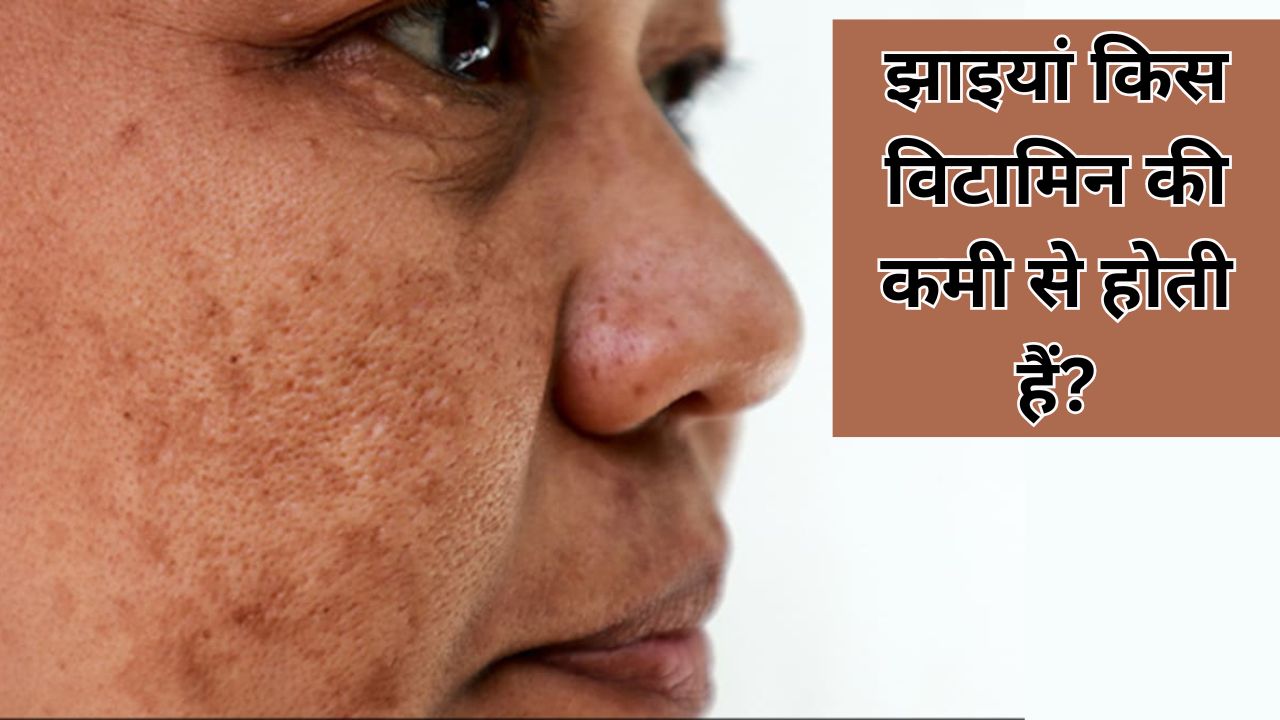 किस विटामिन की कमी से चेहरे पर होने लगती हैं झाइयां?