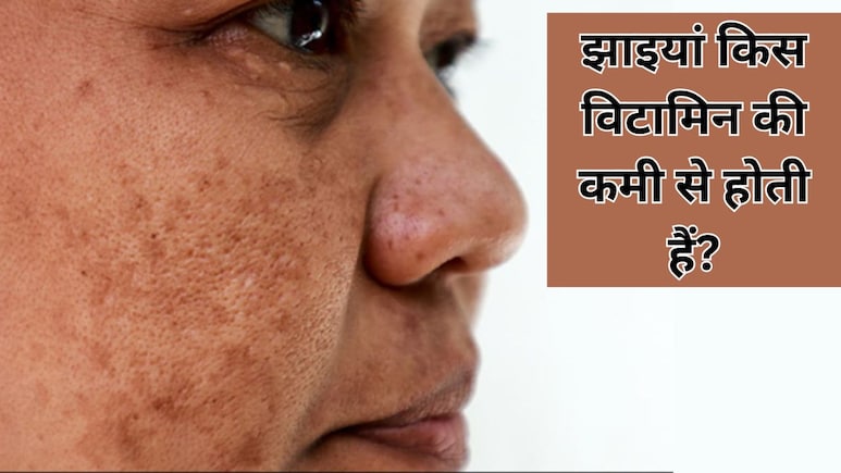 किस विटामिन की कमी से चेहरे पर होने लगती हैं झाइयां?