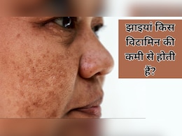किस विटामिन की कमी से चेहरे पर होने लगती हैं झाइयां? किस विटामिन की कमी से चेहरे पर होने लगती हैं झाइयां?