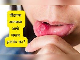 Mouth Ulcer Remedy: तोंड येण्याच्या समस्येमुळे त्रस्त आहात? 3 घरगुती उपाय करा आणि कायमची सुटका मिळवा