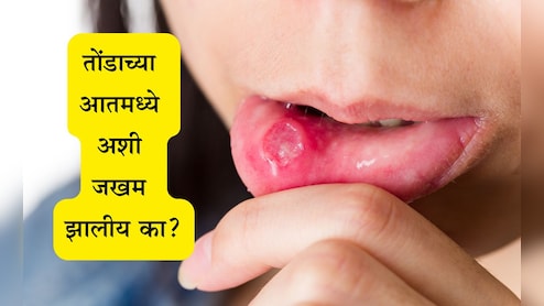 Mouth Ulcer Remedy: तोंड येण्याच्या समस्येमुळे त्रस्त आहात? 3 घरगुती उपाय करा आणि कायमची सुटका मिळवा