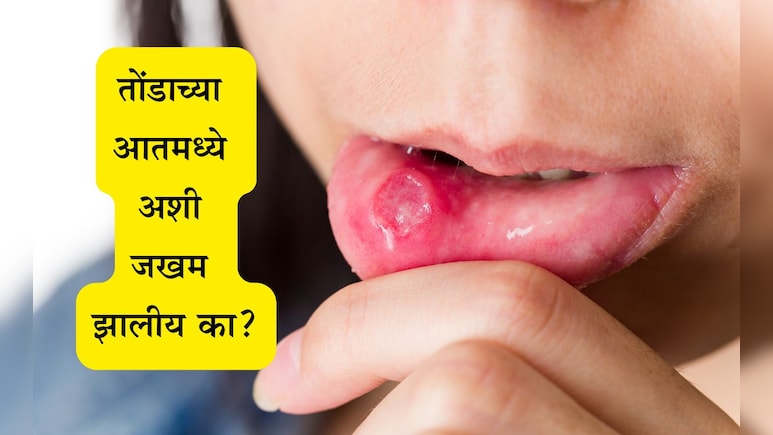 Mouth Ulcer Remedy: तोंड येण्याच्या समस्येमुळे त्रस्त आहात? 3 घरगुती उपाय करा आणि कायमची सुटका मिळवा Mouth Ulcer Remedy: तोंड येण्याच्या समस्येमुळे त्रस्त आहात? 3 घरगुती उपाय करा आणि कायमची सुटका मिळवा