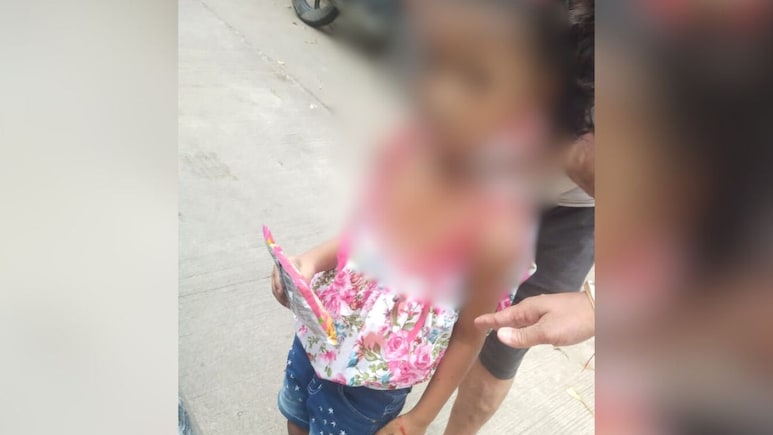 Stray Dogs Attack Nagpur Girl While She Was Playing, Bite Her Hands, Legs Stray Dogs Attack Nagpur Girl While She Was Playing, Bite Her Hands, Legs