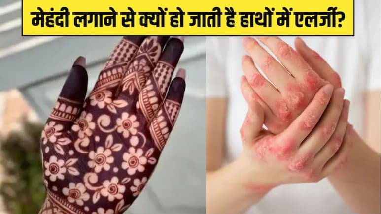 हाथों में मेहंदी लगाने से हो जाती है एलर्जी? डर्मेटोलॉजिस्ट ने बताया कैसे चुनें सही Mehndi