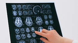 Dementia Cases In India Projected To Nearly Double By 2036
