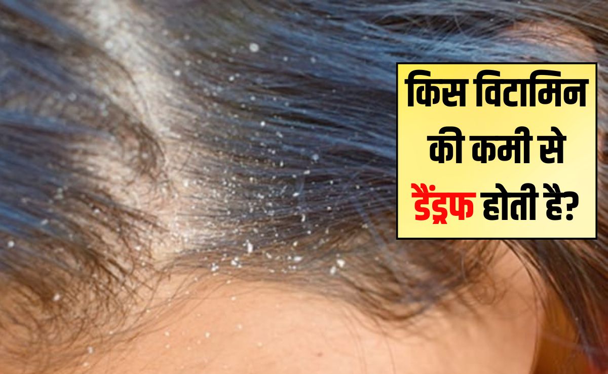 सिर में डैंड्रफ किस विटामिन की कमी से होता है? रूसी के लिए कौन से विटामिन अच्छे हैं, डैंड्रफ का रामबाण इलाज यहां