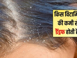 सिर में डैंड्रफ किस विटामिन की कमी से होता है? रूसी के लिए कौन से विटामिन अच्छे हैं, डैंड्रफ का रामबाण इलाज यहां सिर में डैंड्रफ किस विटामिन की कमी से होता है? रूसी के लिए कौन से विटामिन अच्छे हैं, डैंड्रफ का रामबाण इलाज यहां