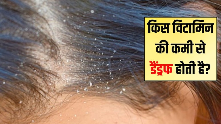 सिर में डैंड्रफ किस विटामिन की कमी से होता है? रूसी के लिए कौन से विटामिन अच्छे हैं, डैंड्रफ का रामबाण इलाज यहां सिर में डैंड्रफ किस विटामिन की कमी से होता है? रूसी के लिए कौन से विटामिन अच्छे हैं, डैंड्रफ का रामबाण इलाज यहां