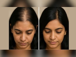 सिर पर धीरे-धीरे कम दिखने लगे हैं बाल? आज से ही फॉलो कर लें ये आयुर्वेदिक नुस्खा, डॉक्टर ने बताया वहीं रुक जाएगा हेयर फॉल सिर पर धीरे-धीरे कम दिखने लगे हैं बाल? आज से ही फॉलो कर लें ये आयुर्वेदिक नुस्खा, डॉक्टर ने बताया वहीं रुक जाएगा हेयर फॉल