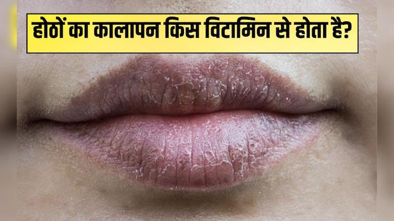 होठों का कालापन किस विटामिन से होता है?