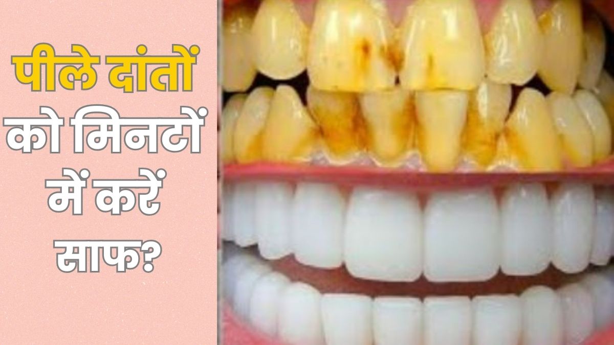पीले दांतों को मोतियों सा चमकाने के घरेलू नुस्खे, चौथा नुस्खा है सबसे असरदार