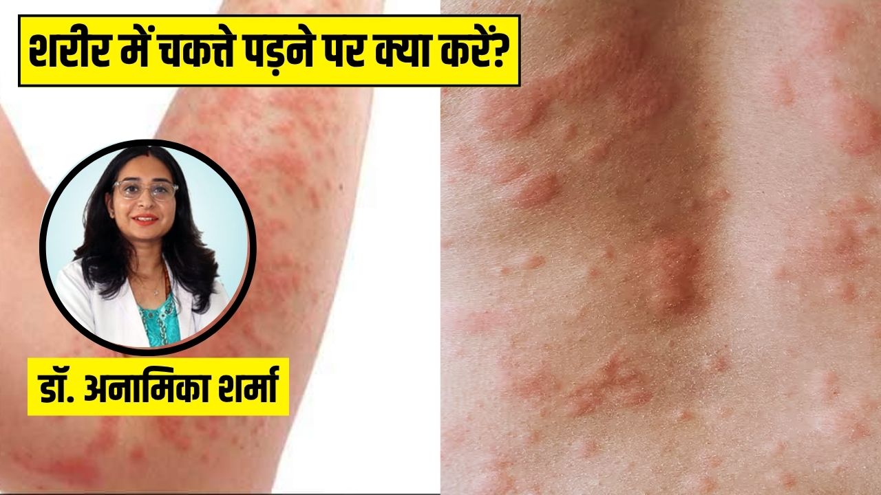 शरीर पर क्यों पड़ जाते हैं लाल रंग के चकत्ते? स्किन की डॉक्टर से जानें ऐसा होने पर सबसे पहले क्या करें