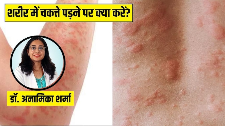 शरीर पर क्यों पड़ जाते हैं लाल रंग के चकत्ते? स्किन की डॉक्टर से जानें ऐसा होने पर सबसे पहले क्या करें शरीर पर क्यों पड़ जाते हैं लाल रंग के चकत्ते? स्किन की डॉक्टर से जानें ऐसा होने पर सबसे पहले क्या करें