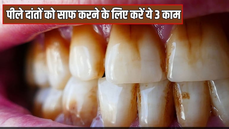 Coffee और सिगरेट पीकर पीले पड़ चुके हैं दांत? डॉक्टर ने बताया इन 3 तरीकों से सफेद हो जाएंगे Yellow Teeth, दूर से नजर आएगी स्माइल Coffee और सिगरेट पीकर पीले पड़ चुके हैं दांत? डॉक्टर ने बताया इन 3 तरीकों से सफेद हो जाएंगे Yellow Teeth, दूर से नजर आएगी स्माइल