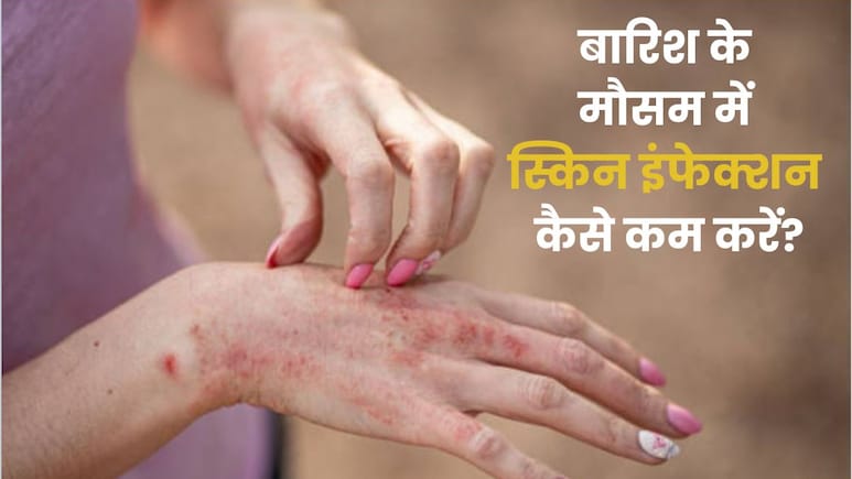 बरसात में स्किन इंफेक्शन से हैं परेशान? न करें ये गलतियां बरसात में स्किन इंफेक्शन से हैं परेशान? न करें ये गलतियां