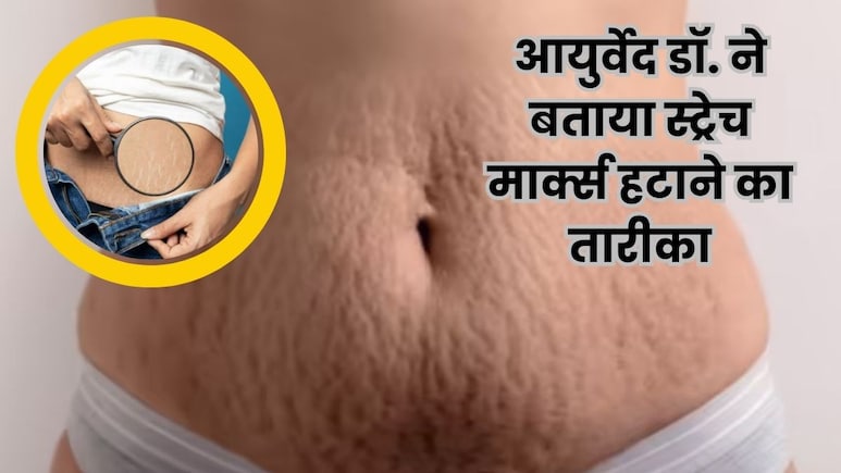 स्ट्रेच मार्क्स को कैसे हटाएं? महंगे क्रीम की जगह आयुर्वेद‍िक डॉक्‍टर का देसी नुस्‍खा आजमाइए