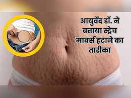 स्ट्रेच मार्क्स को कैसे हटाएं? महंगे क्रीम की जगह आयुर्वेदिक डॉक्टर का देसी नुस्खा आजमाइए स्ट्रेच मार्क्स को कैसे हटाएं? महंगे क्रीम की जगह आयुर्वेदिक डॉक्टर का देसी नुस्खा आजमाइए
