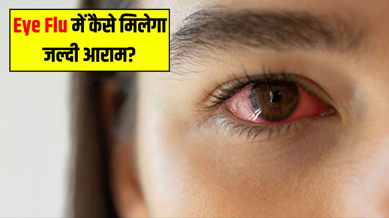 आई फ्लू को जल्दी ठीक कैसे करें? आयुर्वेदिक डॉक्टर ने बताया आंख आने पर घर क्या करें, कैसे मिलेगा तुरंत आराम