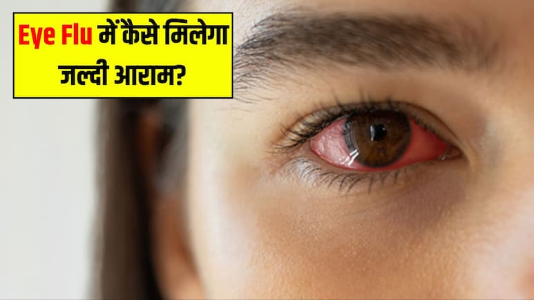 आई फ्लू को जल्दी ठीक कैसे करें? आयुर्वेदिक डॉक्टर ने बताया आंख आने पर घर क्या करें, कैसे मिलेगा तुरंत आराम आई फ्लू को जल्दी ठीक कैसे करें? आयुर्वेदिक डॉक्टर ने बताया आंख आने पर घर क्या करें, कैसे मिलेगा तुरंत आराम