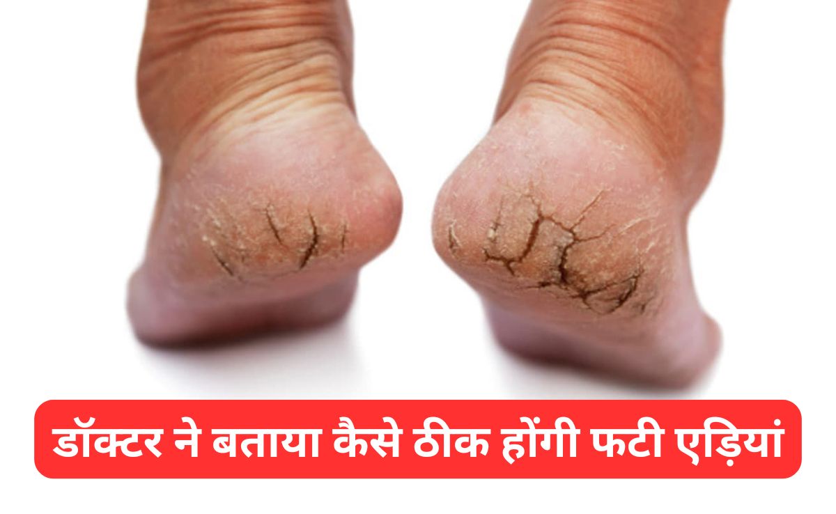 फटी एड़ियों से परेशान हैं तो स्किन डॉक्टर से जानिए कैसे दूर होगी दिक्कत, Cracked Heels हो जाएंगी मुलायम