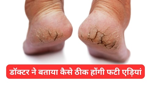 फटी एड़ियों से परेशान हैं तो स्किन डॉक्टर से जानिए कैसे दूर होगी दिक्कत, Cracked Heels हो जाएंगी मुलायम