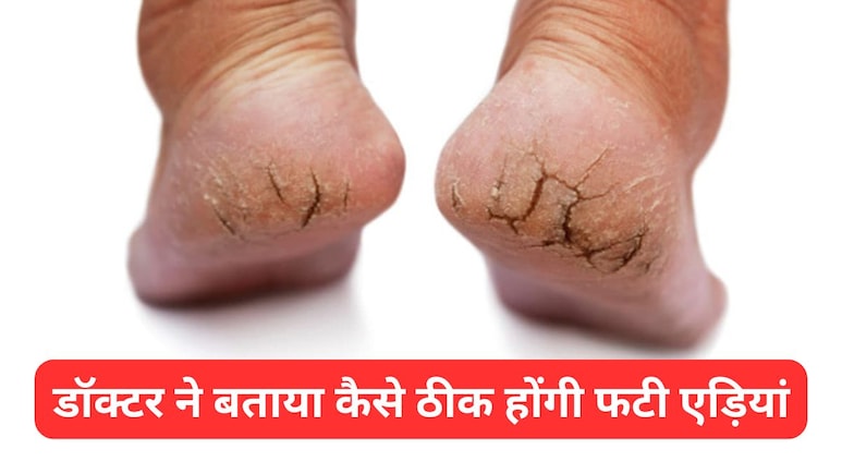 फटी एड़ियों से परेशान हैं तो स्किन डॉक्टर से जानिए कैसे दूर होगी दिक्कत, Cracked Heels हो जाएंगी मुलायम