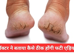 फटी एड़ियों से परेशान हैं तो स्किन डॉक्टर से जानिए कैसे दूर होगी दिक्कत, Cracked Heels हो जाएंगी मुलायम फटी एड़ियों से परेशान हैं तो स्किन डॉक्टर से जानिए कैसे दूर होगी दिक्कत, Cracked Heels हो जाएंगी मुलायम