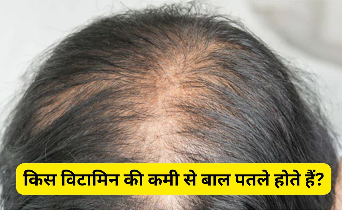 किस विटामिन की कमी से बाल पतले हो जाते हैं?