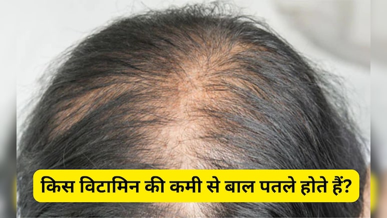 किस विटामिन की कमी से बाल पतले हो जाते हैं?