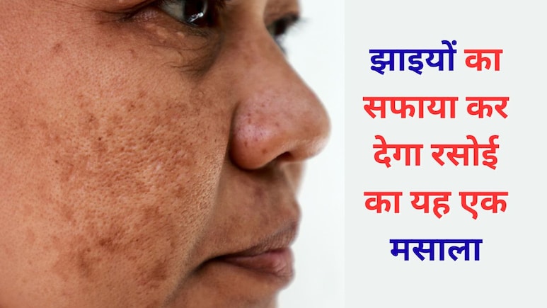 झाइयों से दागदाग नजर आता है चेहरा तो एक्सपर्ट का बताया फेस पैक दिखा सकता है असर, बेदाग नजर आएगी त्वचा