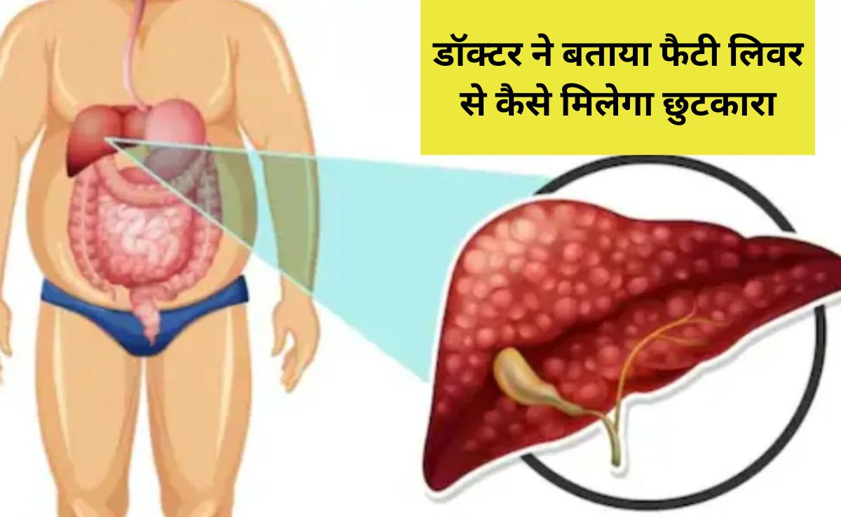 बिना दवाइयों के इस तरह होगी फैटी लिवर की दिक्कत दूर, Dr. Sethi ने बताया घरेलू इलाज