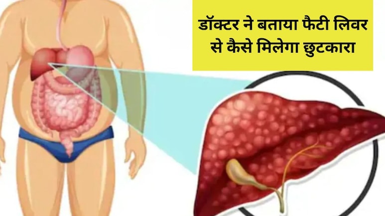 लिवर के डॉक्टर ने बताए फैटी लिवर के सारे सीक्रेट्स, जान लें मास्टर प्लेयर ऑर्गन को पावरफुल बनाने के अचूक उपाय
