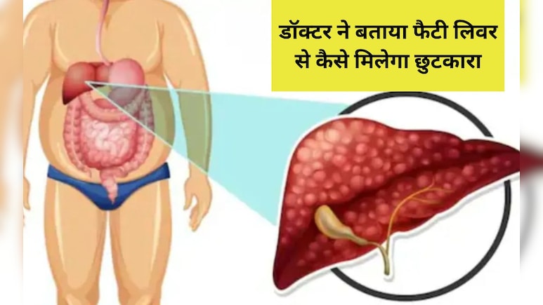 बिना दवाइयों के इस तरह होगी फैटी लिवर की दिक्कत दूर, Dr. Sethi ने बताया घरेलू इलाज