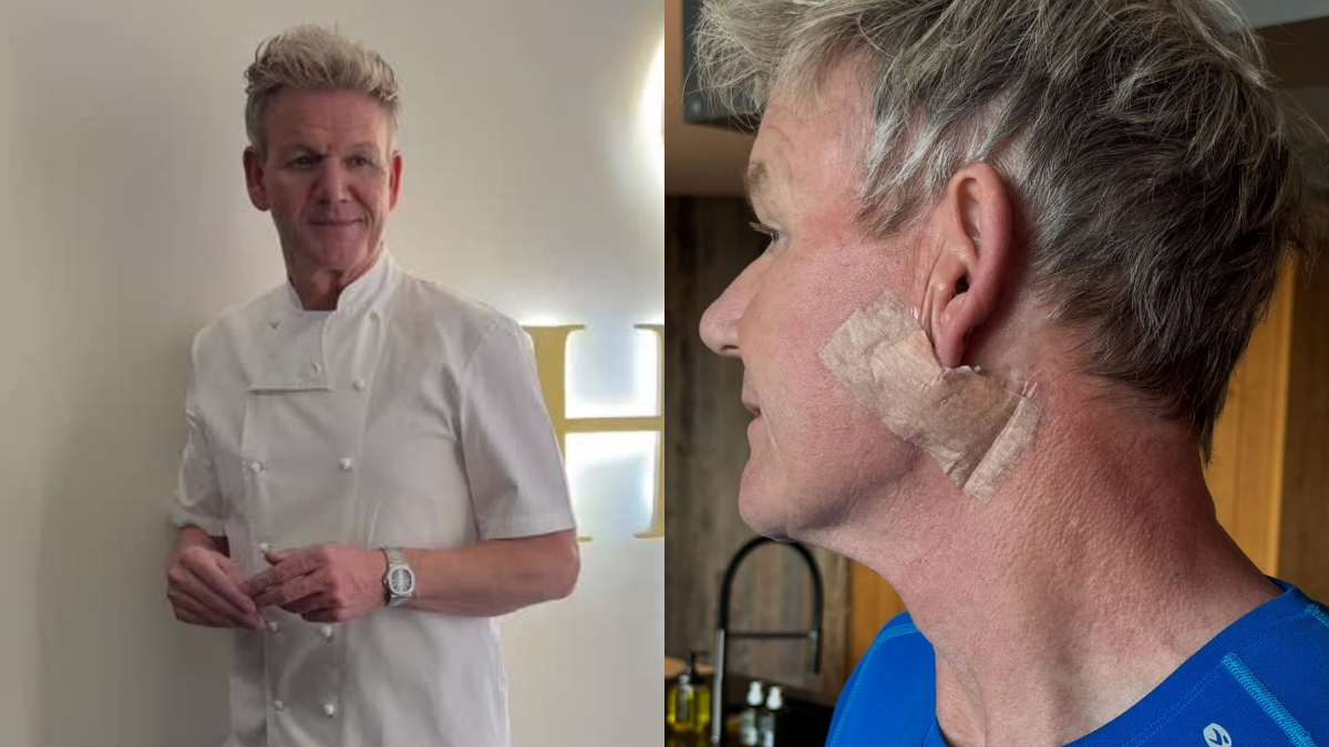 Chef Gordon Ramsay Reveals Skin Cancer Surgery, Urges Fans To Wear Sunscreen