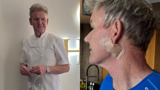 Chef Gordon Ramsay Reveals Skin Cancer Surgery, Urges Fans To Wear Sunscreen
