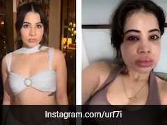 Uorfi Javed Gets Lip Fillers Dissolved After 9 Years, Shares Video Of Swollen And Healed Face