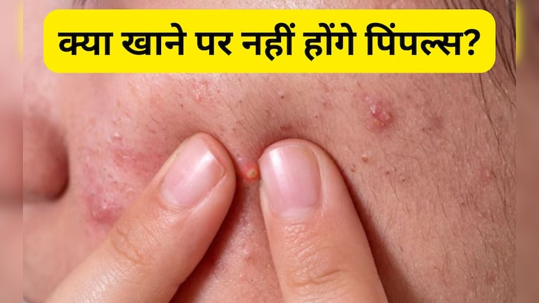 पिंपल्स ज्यादा होते हैं तो खाना शुरू कर दीजिए ये चीजें, स्किन डॉक्टर ने बताया डाइट में कौनसे फूड्स करें शामिल पिंपल्स ज्यादा होते हैं तो खाना शुरू कर दीजिए ये चीजें, स्किन डॉक्टर ने बताया डाइट में कौनसे फूड्स करें शामिल
