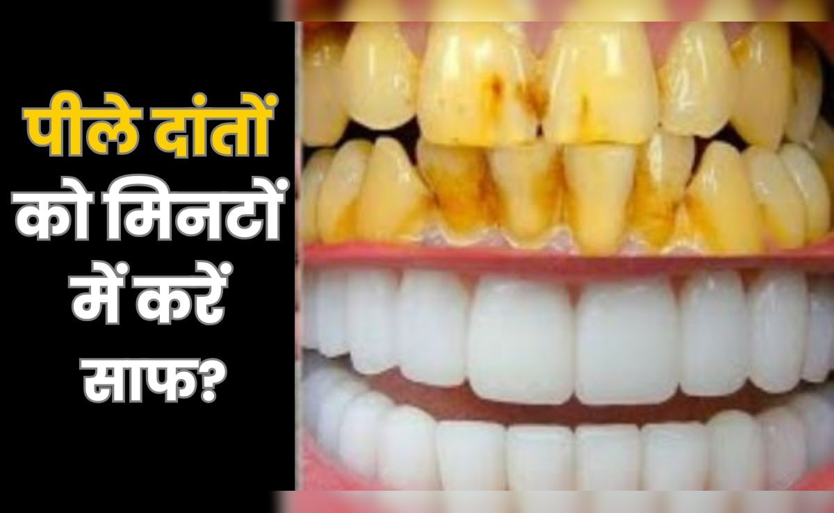 पीले दांतों को मोतियों सा चमकाने के घरेलू नुस्खे, चौथा नुस्खा है सबसे असरदार