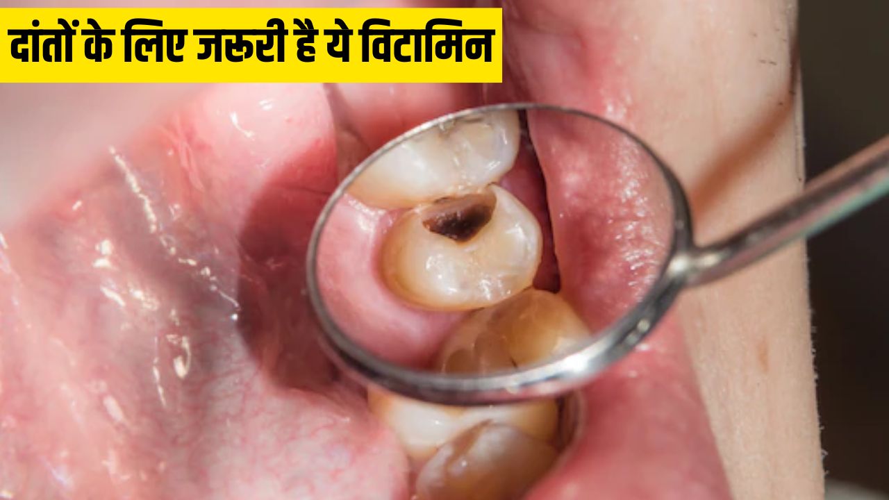 किस विटामिन की कमी से दांतों में लगता है कीड़ा?