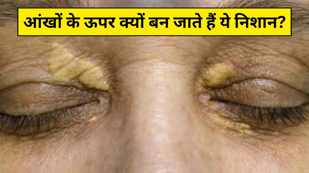 आंखों के ऊपर बन गए हैं पीले निशान? आयुर्वेदिक न्यूट्रिशनिस्ट ने कहा आज से ही कर लें ये 3 काम, जैंथेलास्मा से मिल जाएगा छुटकारा