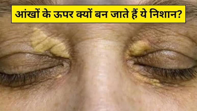 आंखों के ऊपर बन गए हैं पीले निशान? आयुर्वेदिक न्यूट्रिशनिस्ट ने कहा आज से ही कर लें ये 3 काम, जैंथेलास्मा से मिल जाएगा छुटकारा