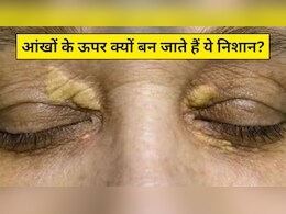 आंखों के ऊपर बन गए हैं पीले निशान? आयुर्वेदिक न्यूट्रिशनिस्ट ने कहा आज से ही कर लें ये 3 काम, जैंथेलास्मा से मिल जाएगा छुटकारा आंखों के ऊपर बन गए हैं पीले निशान? आयुर्वेदिक न्यूट्रिशनिस्ट ने कहा आज से ही कर लें ये 3 काम, जैंथेलास्मा से मिल जाएगा छुटकारा