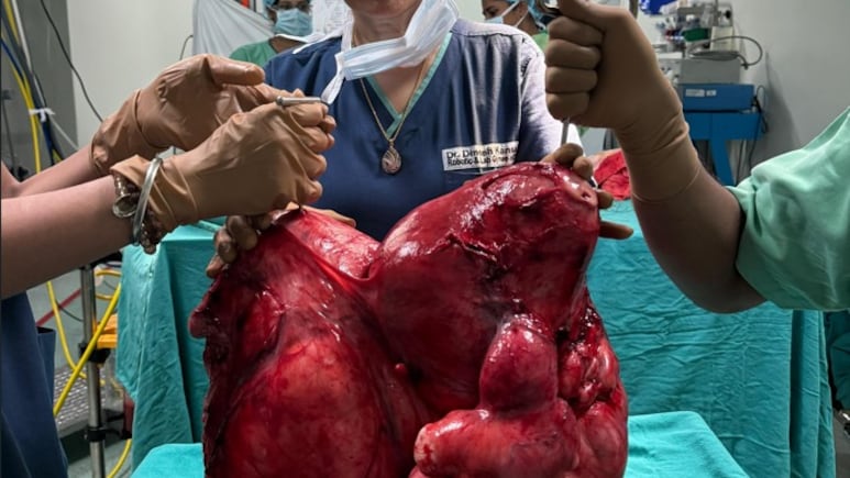 डॉक्टरों की टीम ने महिला के गर्भाशय से निकाला 18.5 KG का ट्यूमर, जानें लक्षण, कारण और इलाज