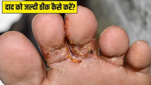 बारिश के पानी से पैरों में हो गया है दाद? आयुर्वेदिक डॉक्टर प्रताप चौहान ने बताया कैसे रोके फंगल इंफेक्शन, ज्यादा नहीं बढ़ेगी सड़न