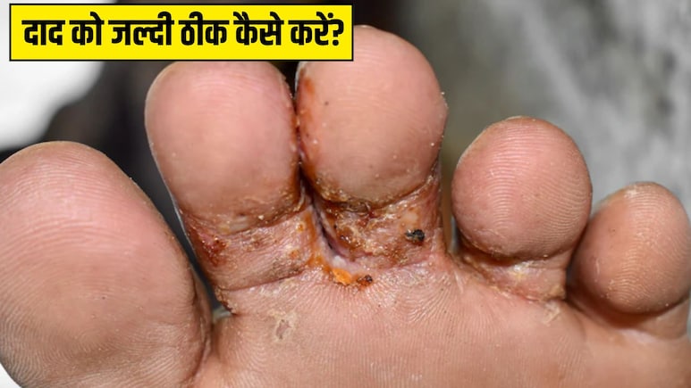 बारिश के पानी से पैरों में हो गया है दाद? आयुर्वेदिक डॉक्टर प्रताप चौहान ने बताया कैसे रोके फंगल इंफेक्शन, ज्यादा नहीं बढ़ेगी सड़न