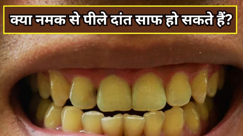 क्या नमक के पानी से पीले दांत साफ हो सकते हैं? क्या नमक के पानी से पीले दांत साफ हो सकते हैं?